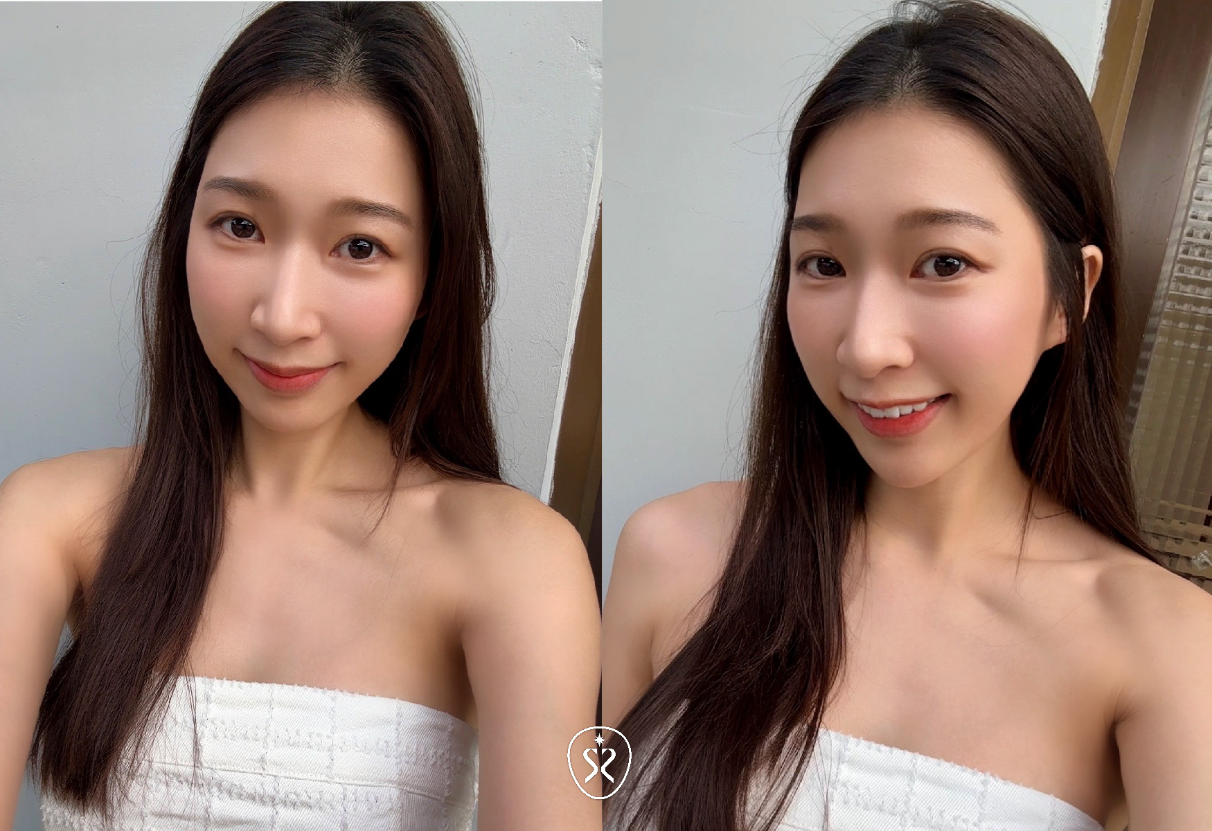 透過玻尿酸微整注射微調帶來自然且立體的輪廓改變